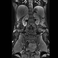МРТ брюшной полости и забрюшинного пространства снимок